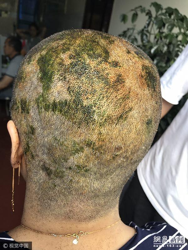 女子染发头皮变绿休克 入院后被剃光头_图片频道__中国青年网