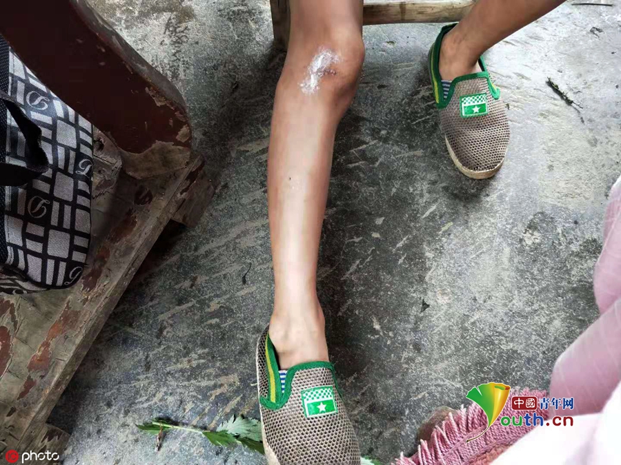 割艾叶时,郑牛腿上受伤留下的痕迹.图片署名:ic photo